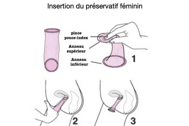 preservatif-feminin-explications-comment-mettre-preservatif-feminin-comment-enlever-preservatif-feminin-presentation-preservatif-feminin-anneaux-preservatif-feminin-insertion-vagin-preservatif-feminin