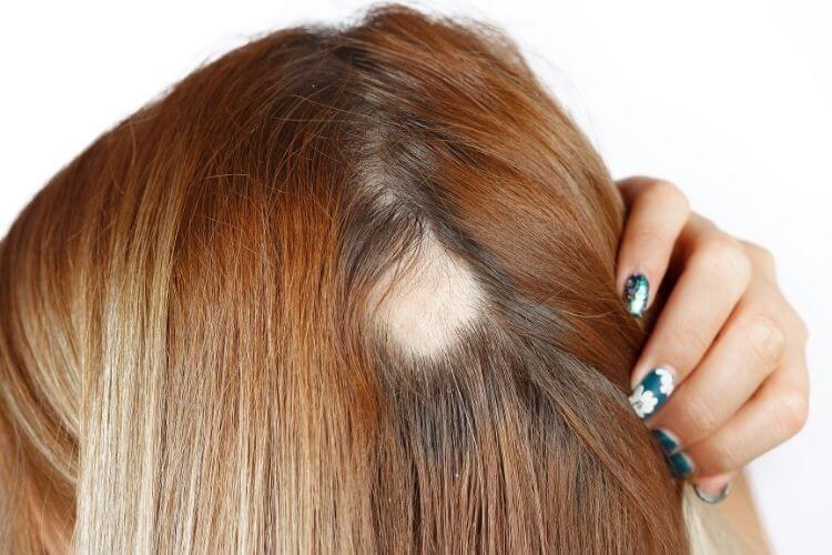 Moins de Cheveux.... Pourquoi et Que faire devant cette alopécie?
