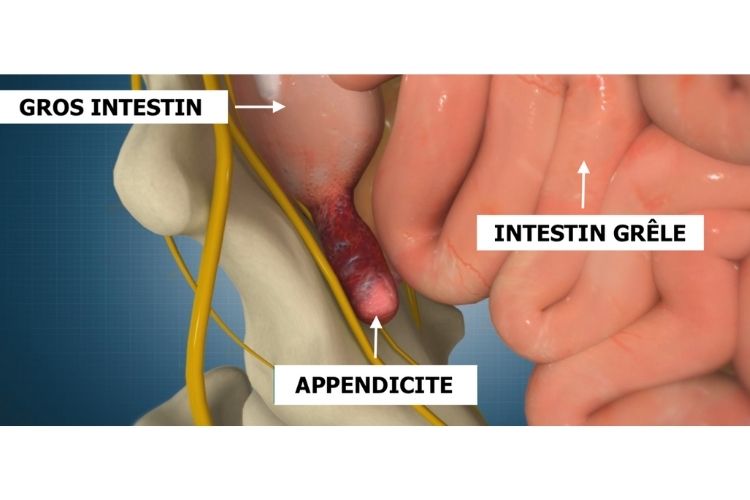 L'Appendicite: c'est quoi et Comment gérer?