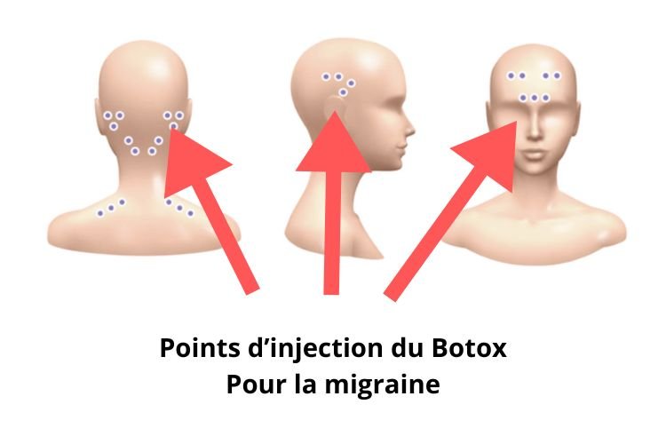 où-injecter-le-botox-pour-les-migraines