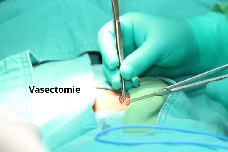 chirurgie-de-contraception-masculine-la-vasectomie