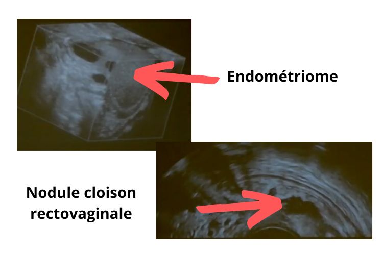 l-echographie-permet-de-diagnostiquer-l-endometriose